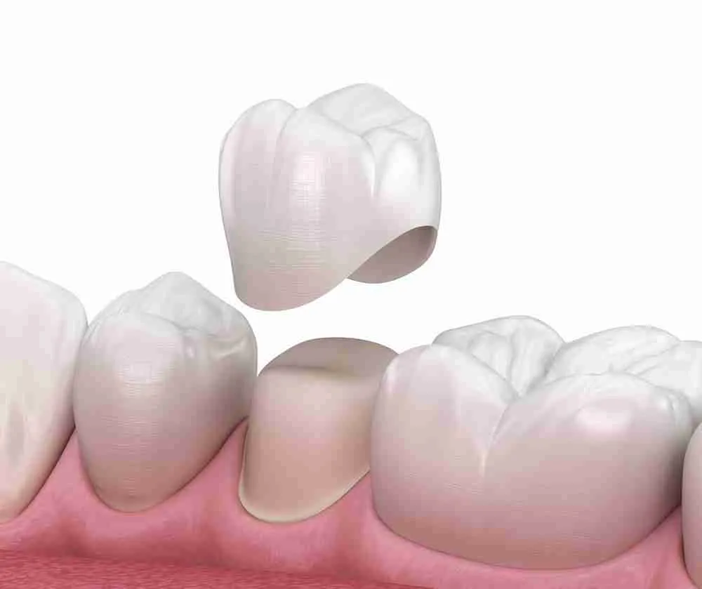 Làm răng sứ là gì? 