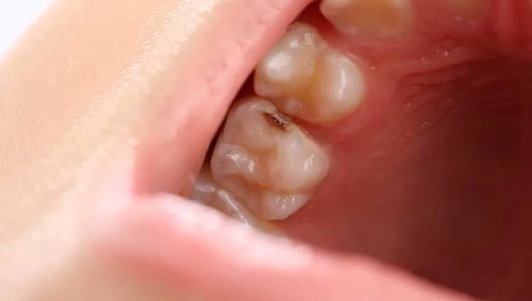 Sâu men là giai đoạn mới hình thành ổ sâu với những tổn thương nhẹ, đây cũng là giai đoạn dễ dàng điều trị nhất nếu sớm phát hiện